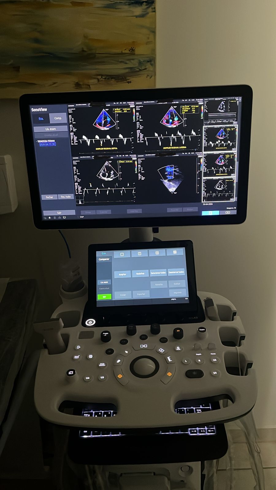 Equipamento de Ecocardiografia - Tecnologia de ponta para exames cardíacos